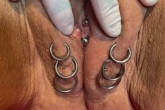 labia ladder